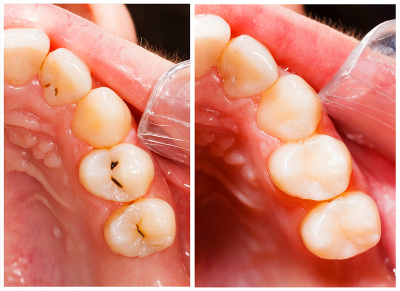Composite Fillings in Monterey | Hardy Dental