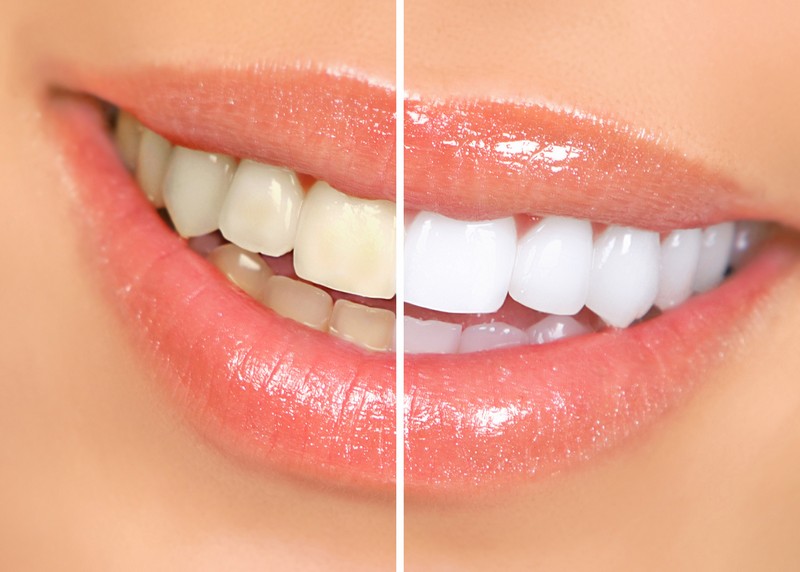 Teeth Whitening in Monterey | Hardy Dental