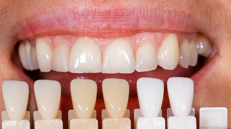 Porcelain Veneers in Monterey | Hardy Dental